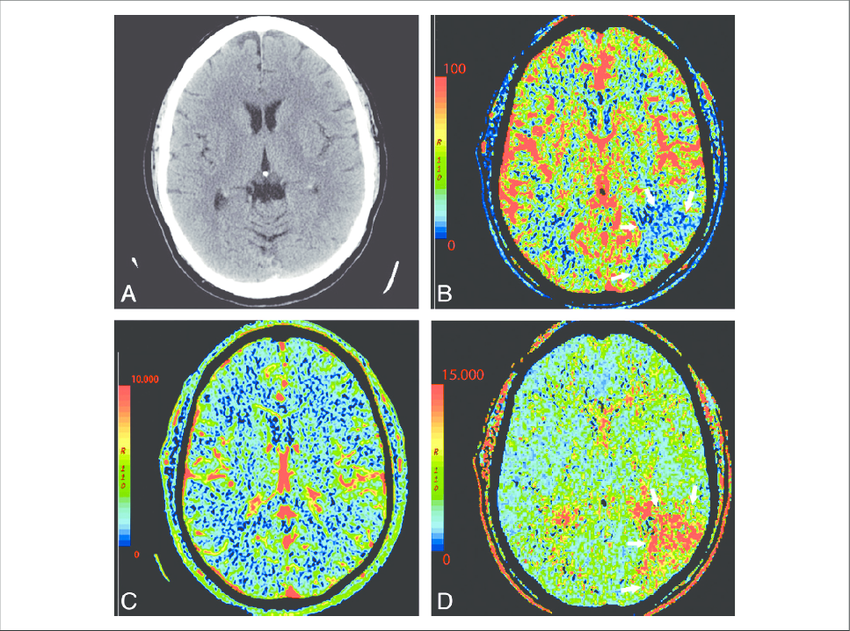 MCA Territory Infarct Treatment